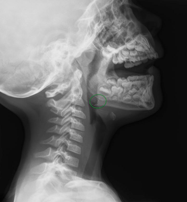 Cerda de cepillo de BBQ en rayos X (lateral)
