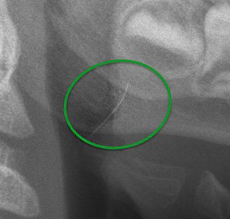 Cerda de cepillo de BBQ en rayos X (lateral) – acercamiento