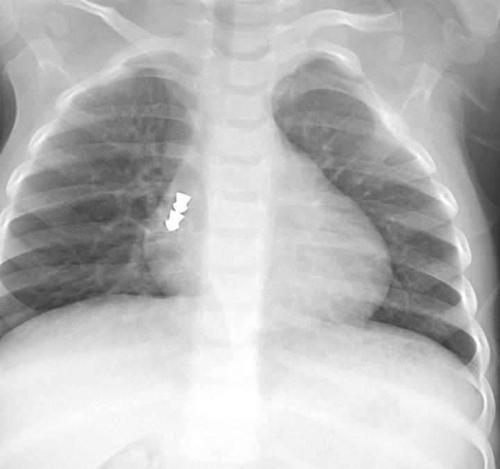 Radiographie de balles BB dans une bronche (a.-p.)