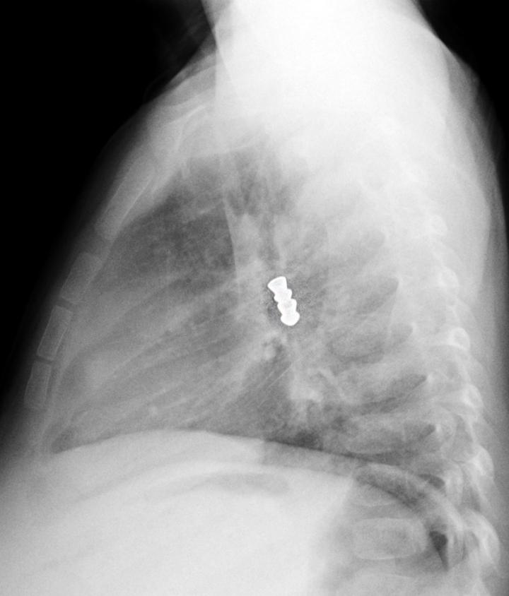Radiographie de balles BB dans une bronche (latéral)