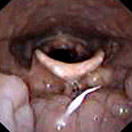 Hypopharynx