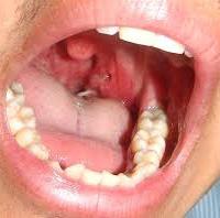 Fishbone in Tonsil