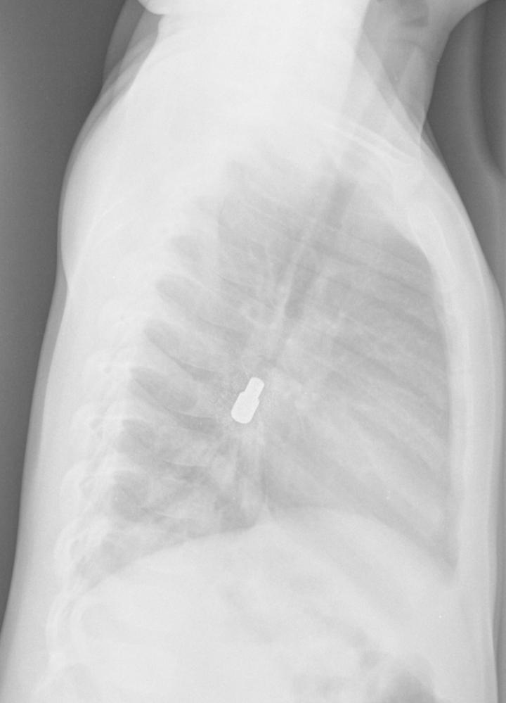 Radiografia de parador de porta (lateral)