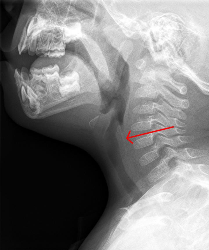 魚骨X光側位片