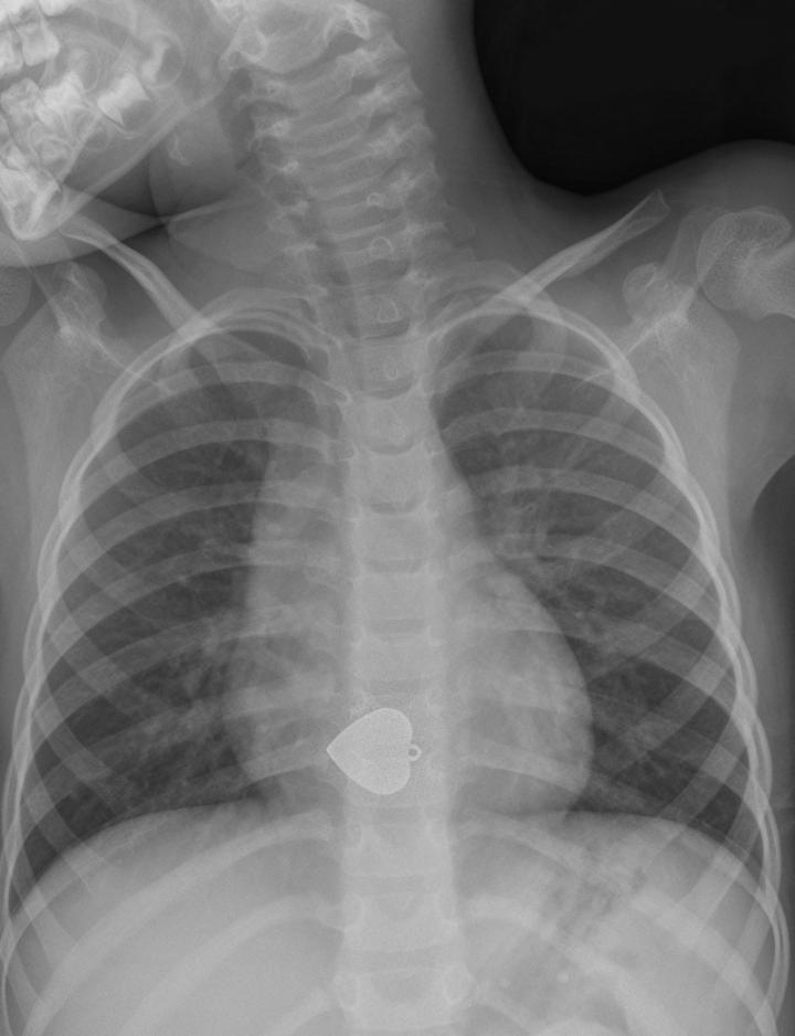 Radiographie d'un pendentif en forme de cœur (a.-p.)