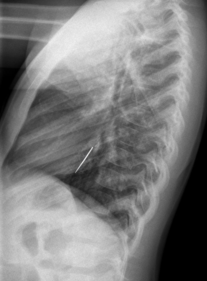 Radiographie d'un pendentif en forme de cœur (latéral)