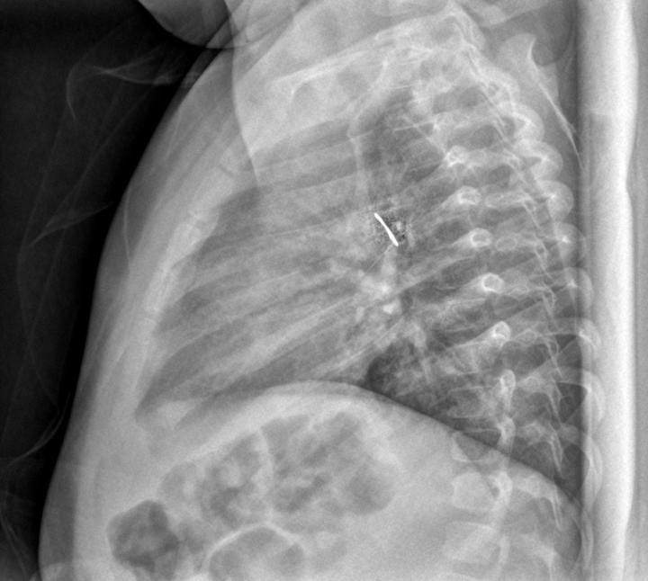 Bombillo de linterna en rayos X (lateral)