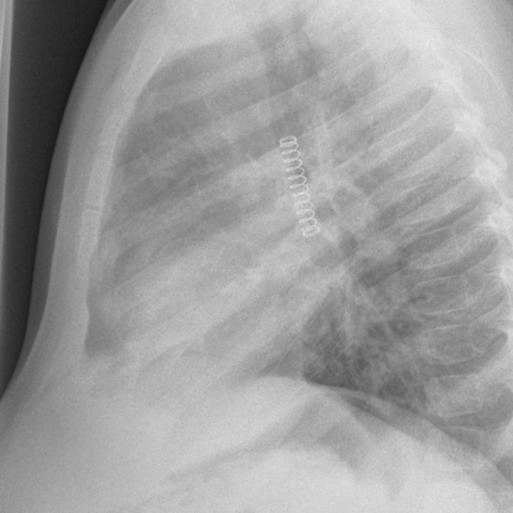 Radiographie d'un ressort de stylo (latéral)