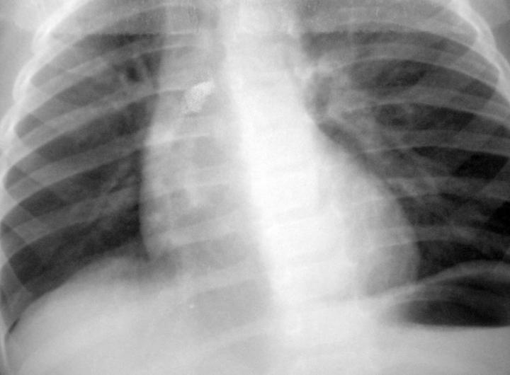 支气管里的鹅卵石X光片