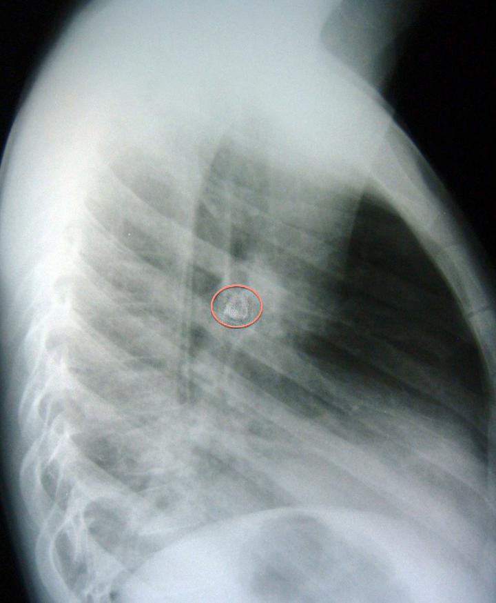 Muela en rayos X (lateral)
