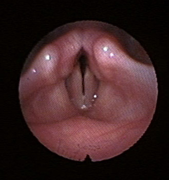 (Nearly Completely) Closed Vocal Cords