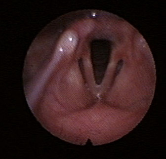 Open Vocal Cords