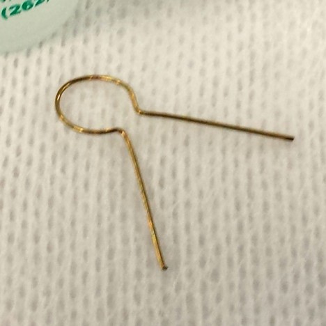 Christmas ornament hardware removed from the esophagus and hypopharnx