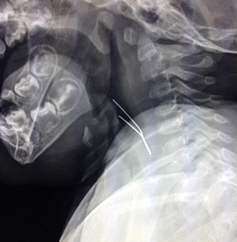 Christmas ornament hardware in the esophagus and hypopharnx