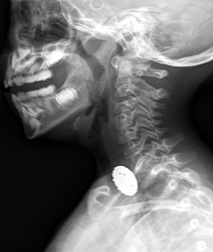 Botón de abrigo en rayos X (lateral)
